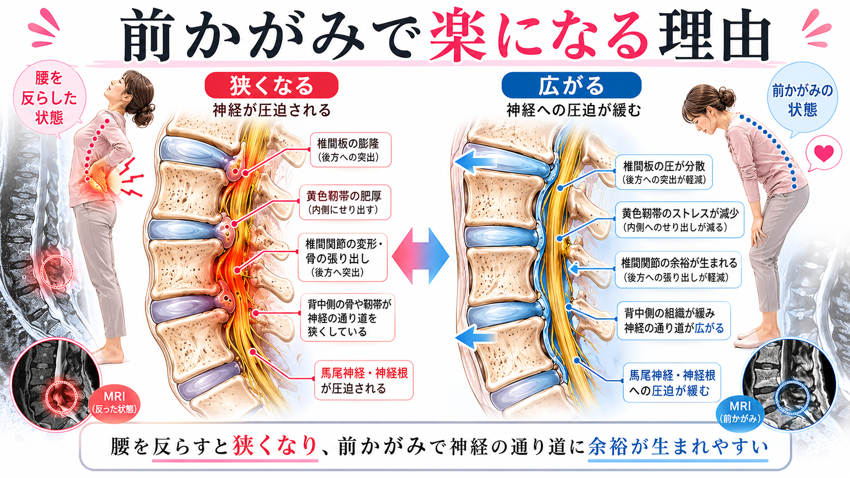 脊柱管狭窄症で腰を反らすと神経の通り道が狭くなり、前かがみで楽になる理由を示した医学図解