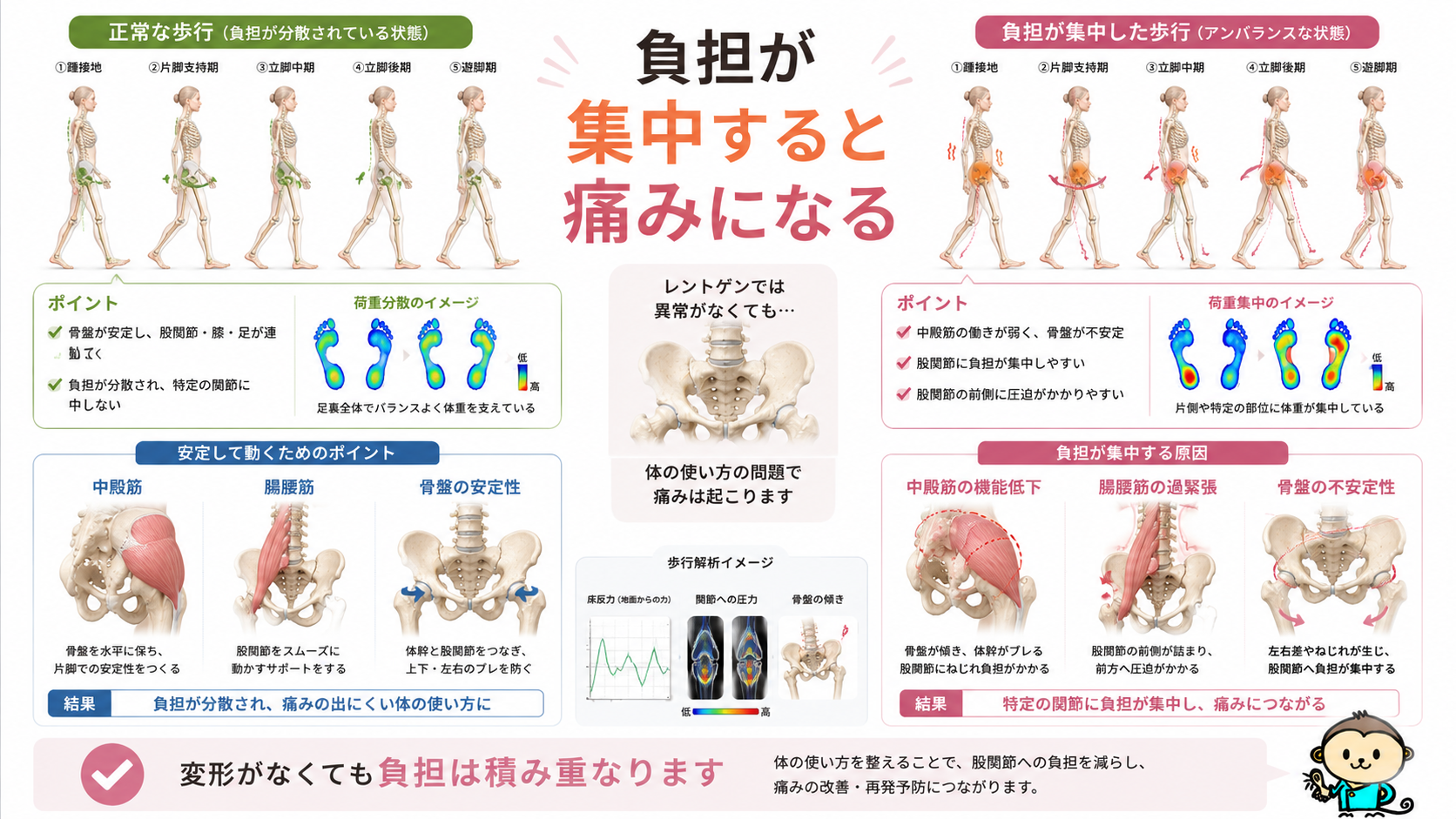 正常な歩行と股関節に負担が集中した歩行を比較し、変形がなくても股関節痛が起こるメカニズムを示した図解