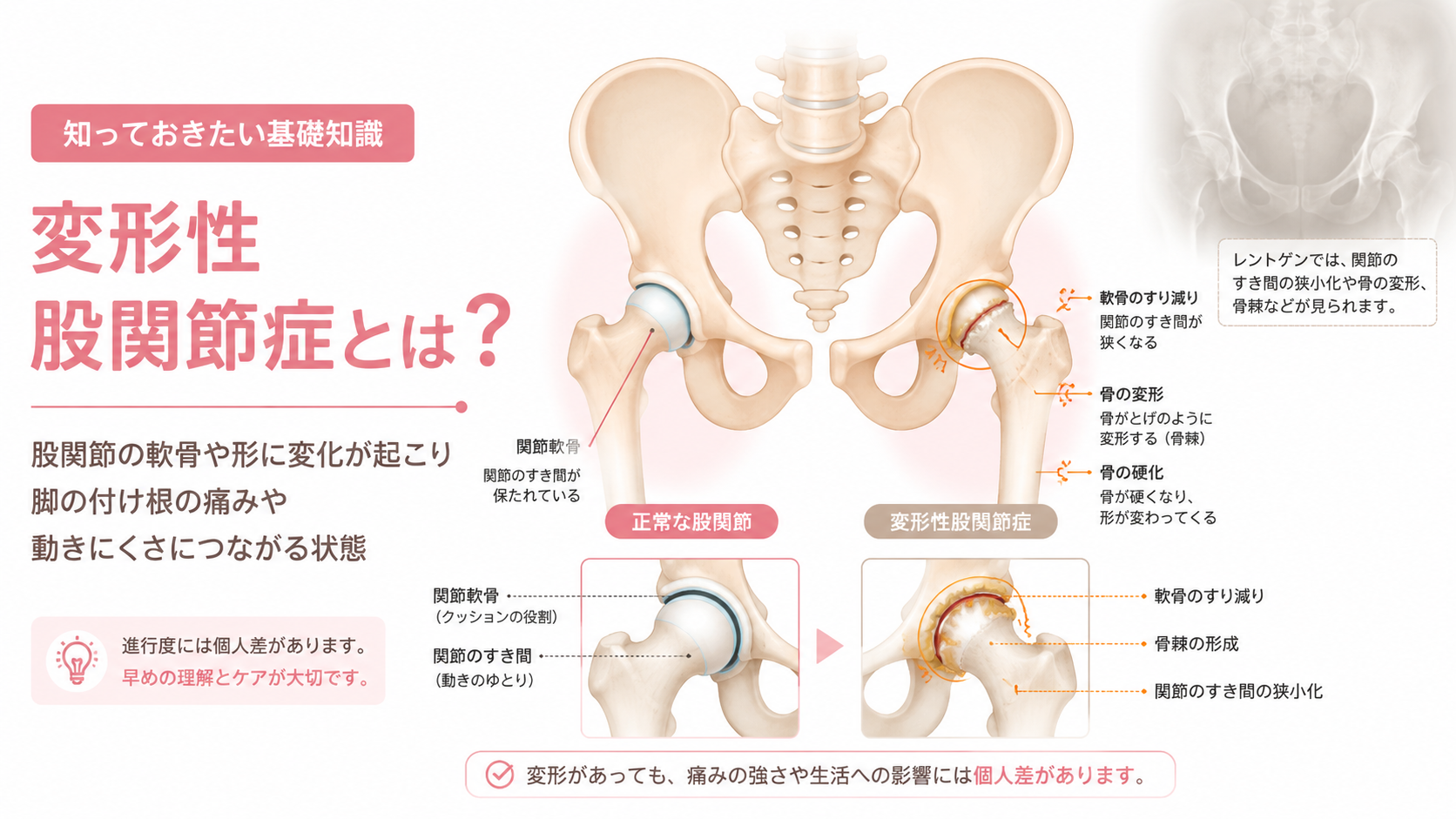 正常な股関節と変形性股関節症の股関節を比較し、軟骨のすり減りや関節のすき間の狭さを説明する医療図解画像