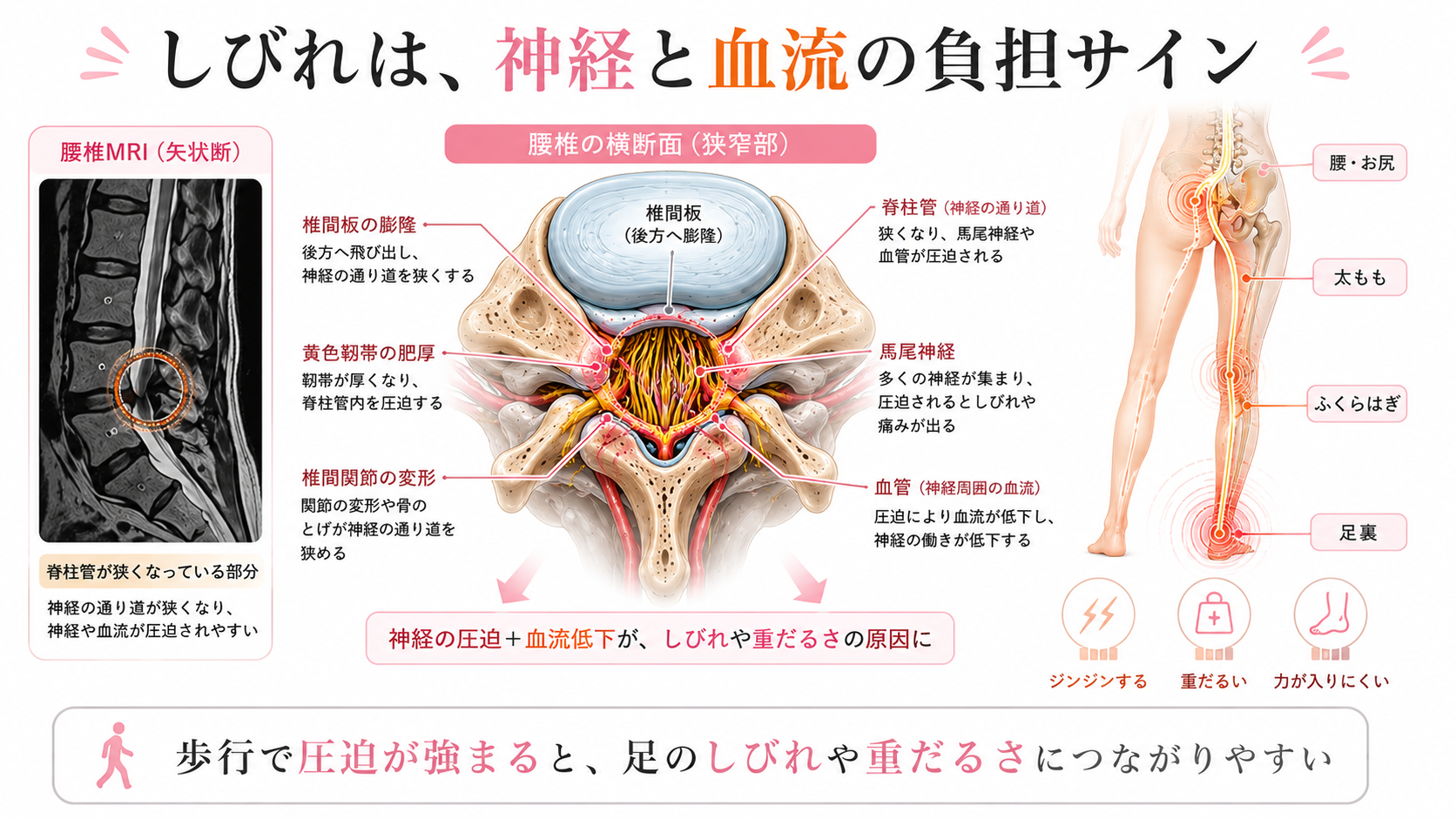 脊柱管狭窄症による足のしびれが神経圧迫と血流低下に関係することを腰椎横断面と足の神経ラインで示した図解