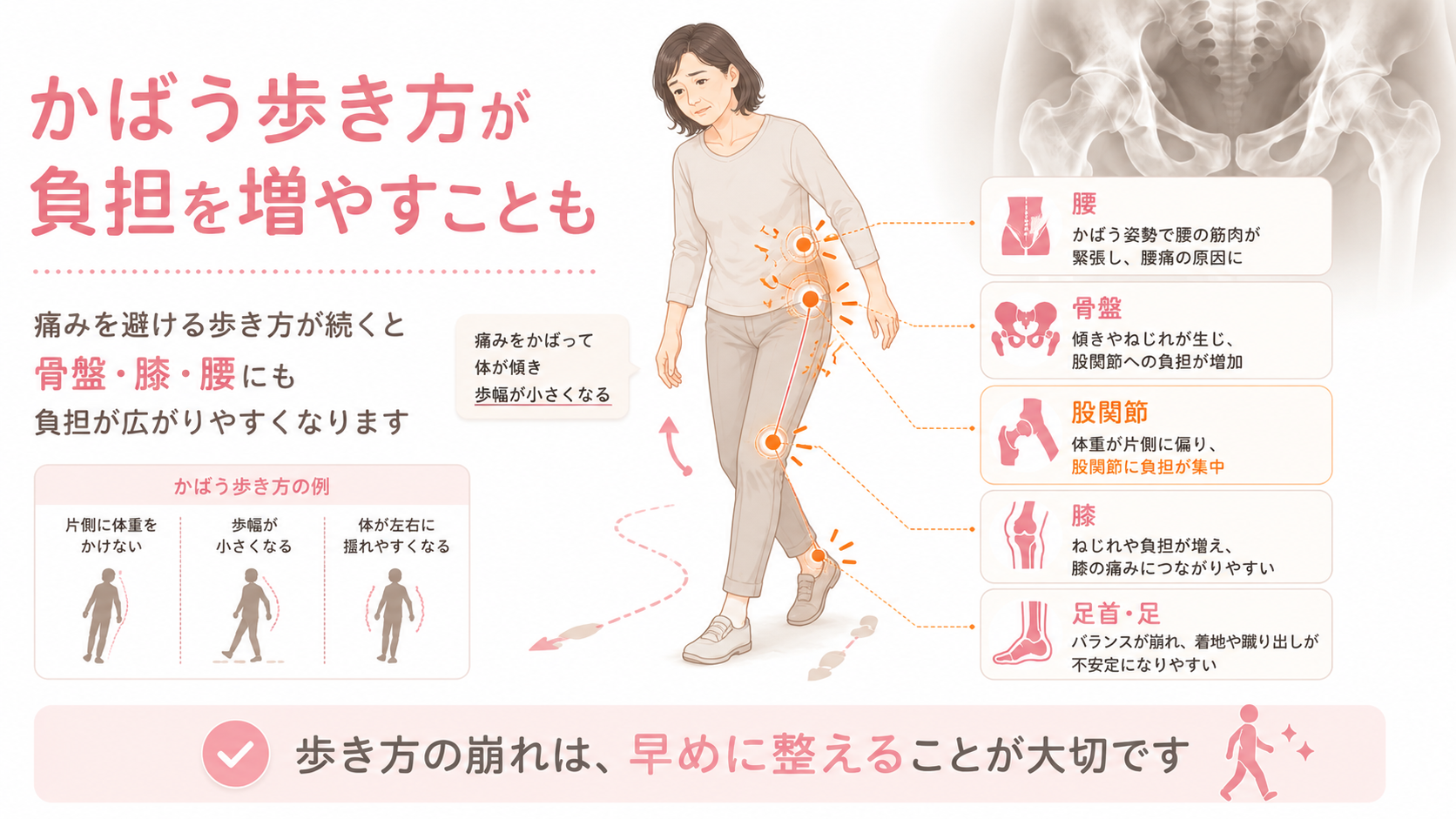 股関節痛をかばう歩き方によって骨盤・腰・膝へ負担が広がる流れを説明する医療整体図解画像
