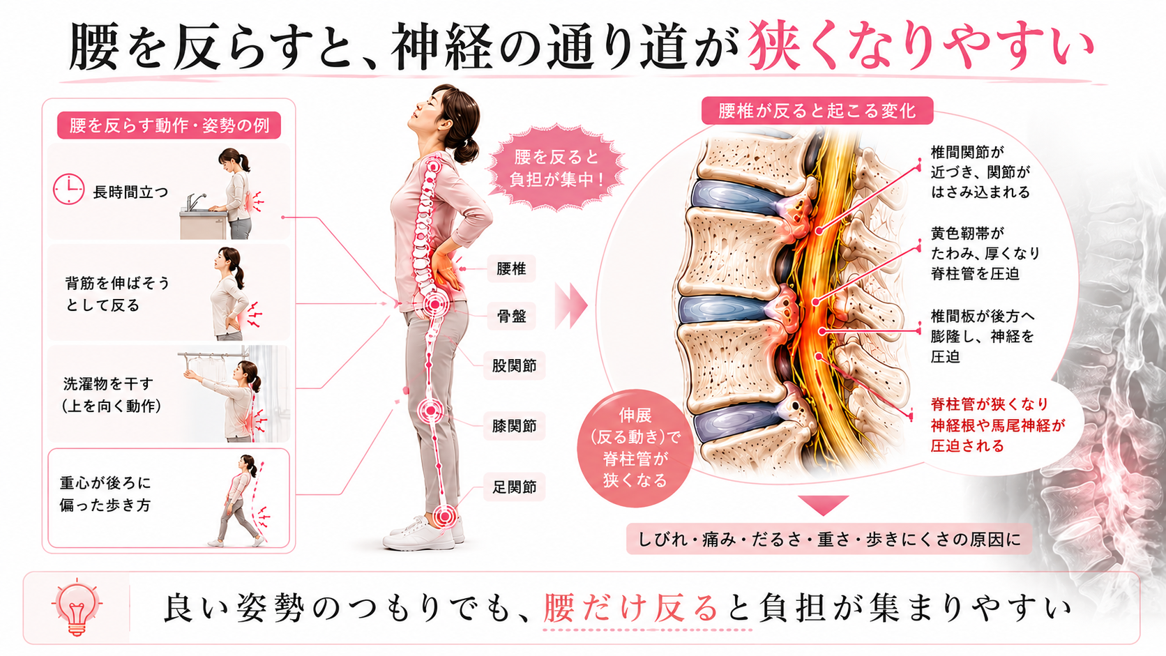腰を反らす姿勢で脊柱管が狭くなり、神経圧迫によってしびれや歩きにくさが出やすくなる理由を示した医学図解