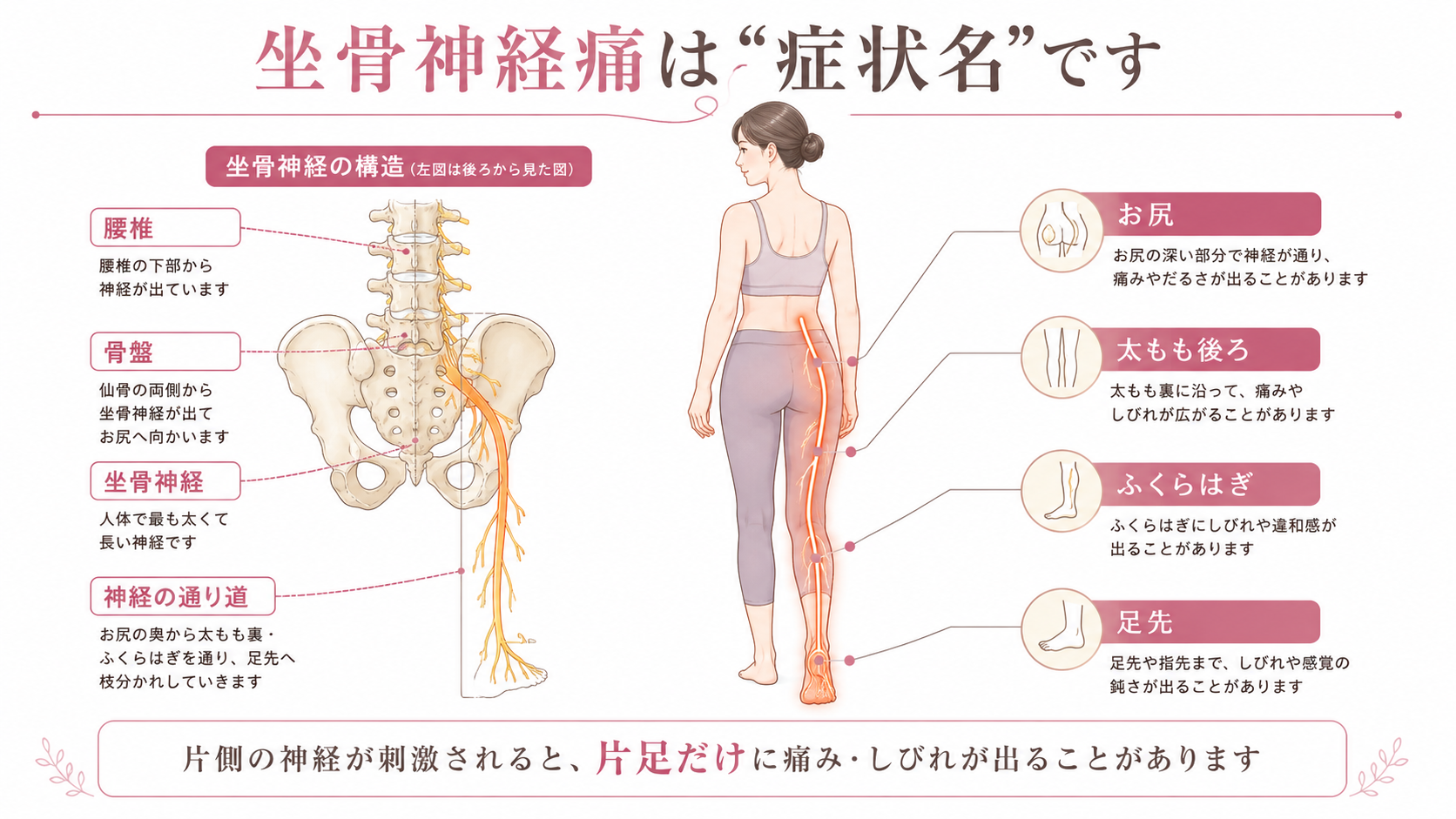 坐骨神経痛の仕組みを腰椎・骨盤・坐骨神経の走行と片足のしびれラインで説明した医学図解