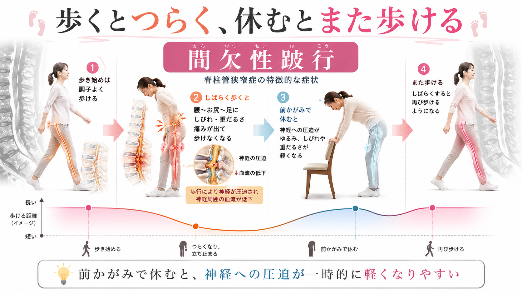 脊柱管狭窄症で歩くと足がしびれ、前かがみで休むとまた歩ける間欠性跛行の流れを示した図解