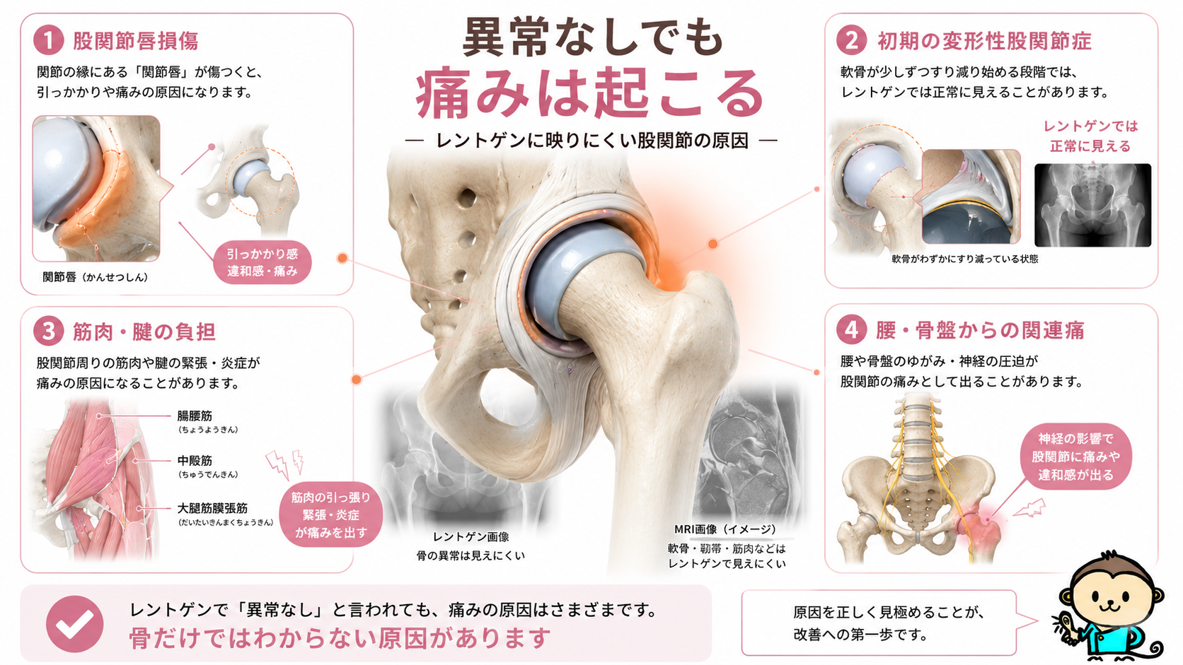 股関節唇損傷、初期の変形性股関節症、筋肉や腱の負担、腰や骨盤からの関連痛など、レントゲンに映りにくい股関節痛の原因を示した図解