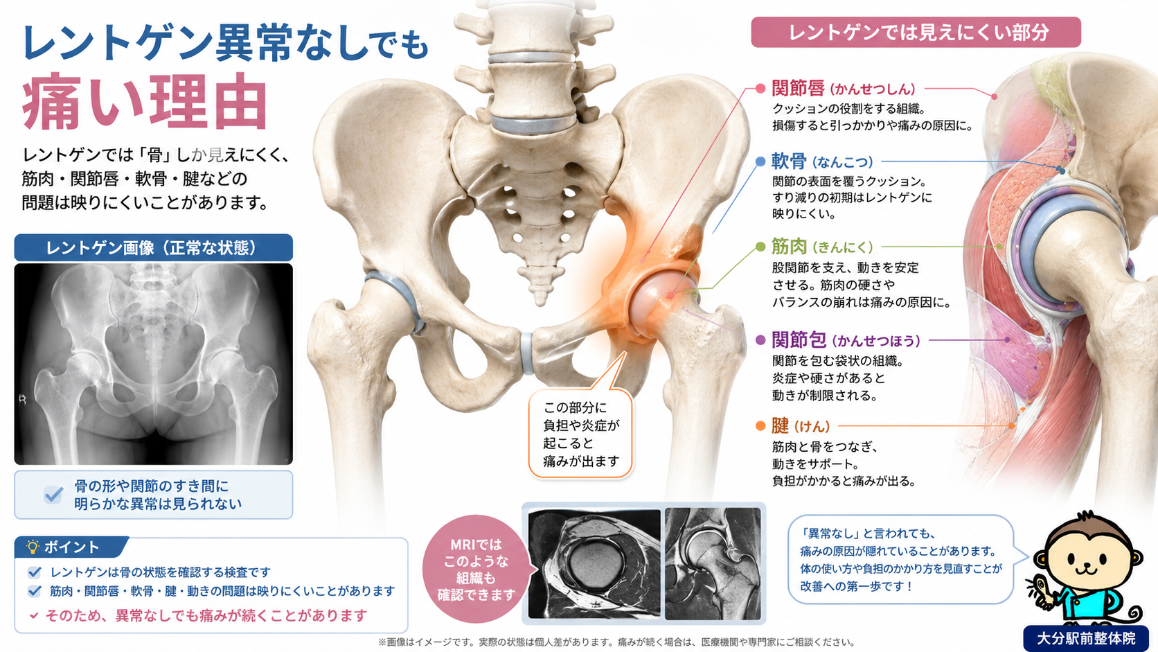 股関節痛でレントゲン異常なしと言われても、関節唇や軟骨、筋肉、腱など骨以外の問題で痛みが出る理由を示した医学図解