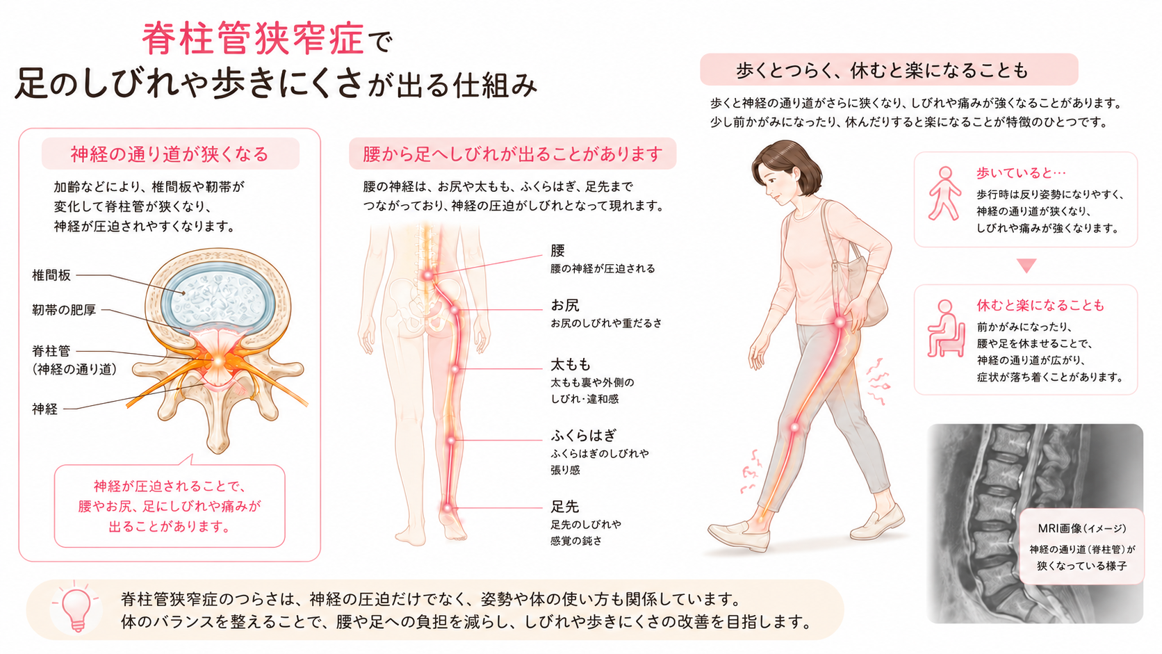 脊柱管狭窄症で神経の通り道が狭くなり、腰から足へしびれや歩きにくさが出る仕組みの図解