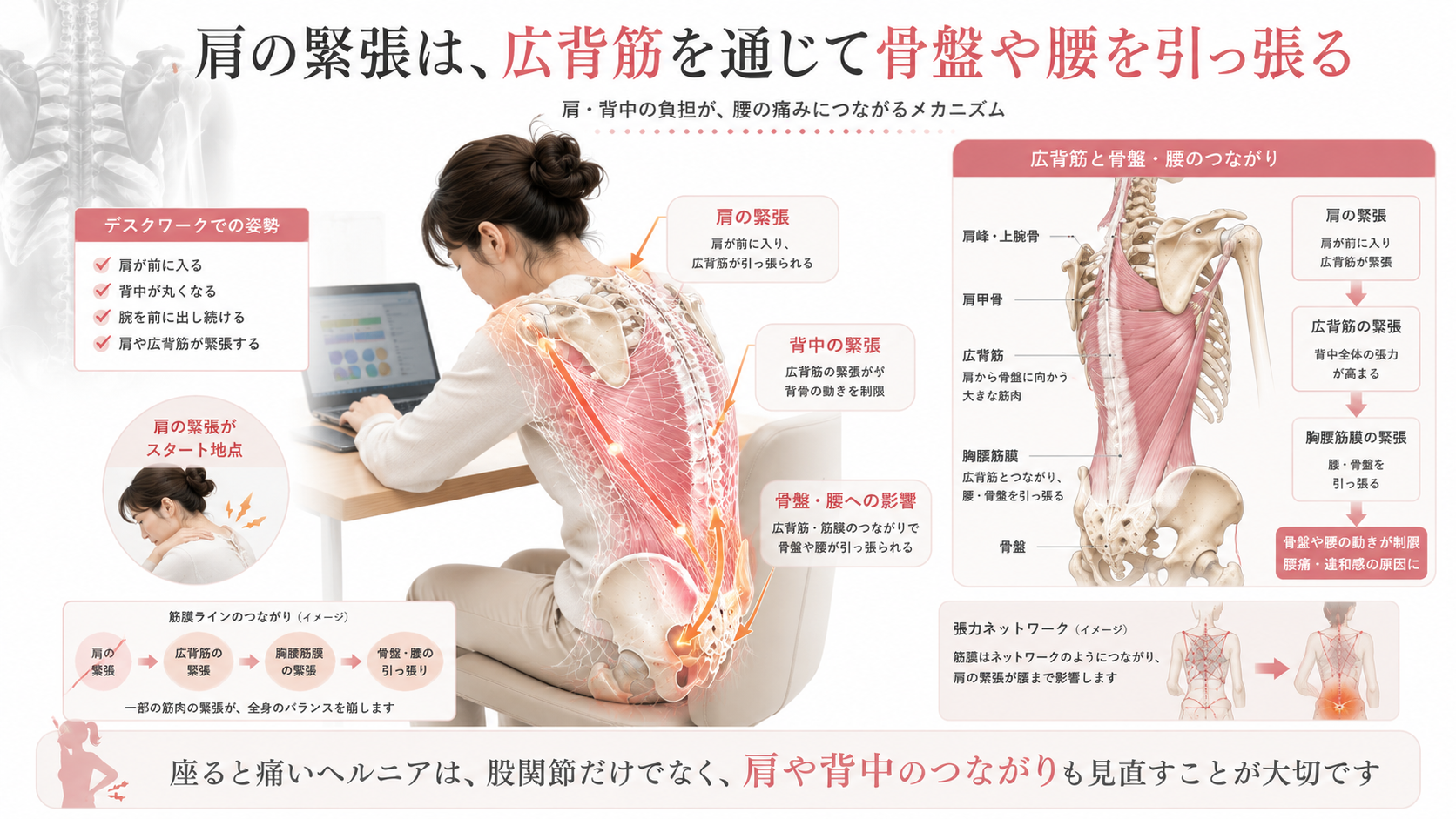 デスクワーク中の肩の緊張が広背筋を通じて骨盤や腰を引っ張り、ヘルニアの座る痛みに影響する仕組みの図解