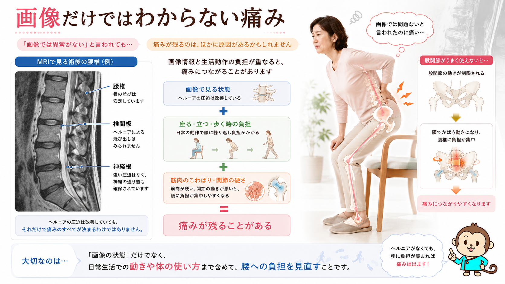 MRIで大きな異常がなくても日常動作や筋肉のこわばりで腰痛が残ることを説明する医学図解