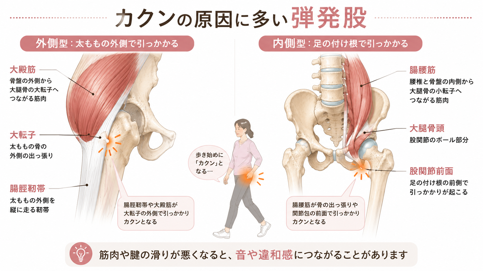弾発股による股関節のカクンを、腸脛靭帯・大殿筋・腸腰筋の引っかかりから説明した医学図解画像