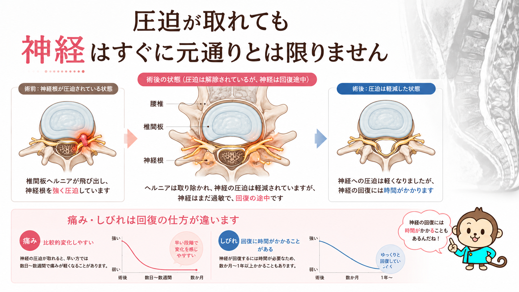椎間板ヘルニア手術後に神経の圧迫が取れても回復に時間がかかることを示す腰椎断面図