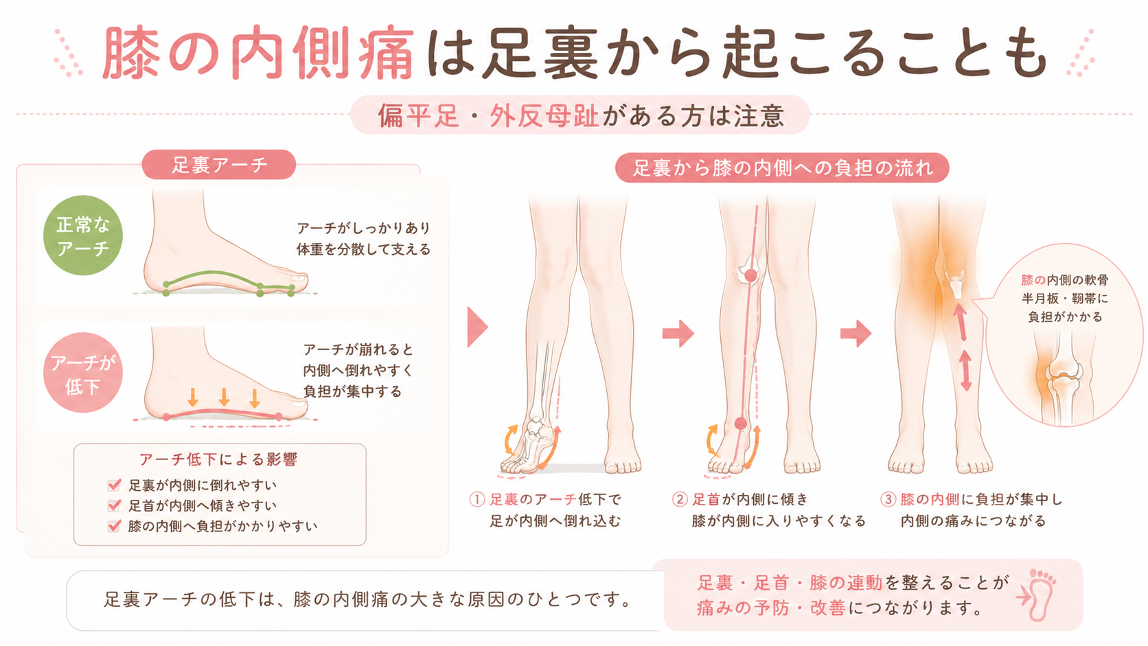 足裏アーチの低下により足首が内側へ倒れ、膝の内側に負担がかかる仕組みを説明した医学図解画像