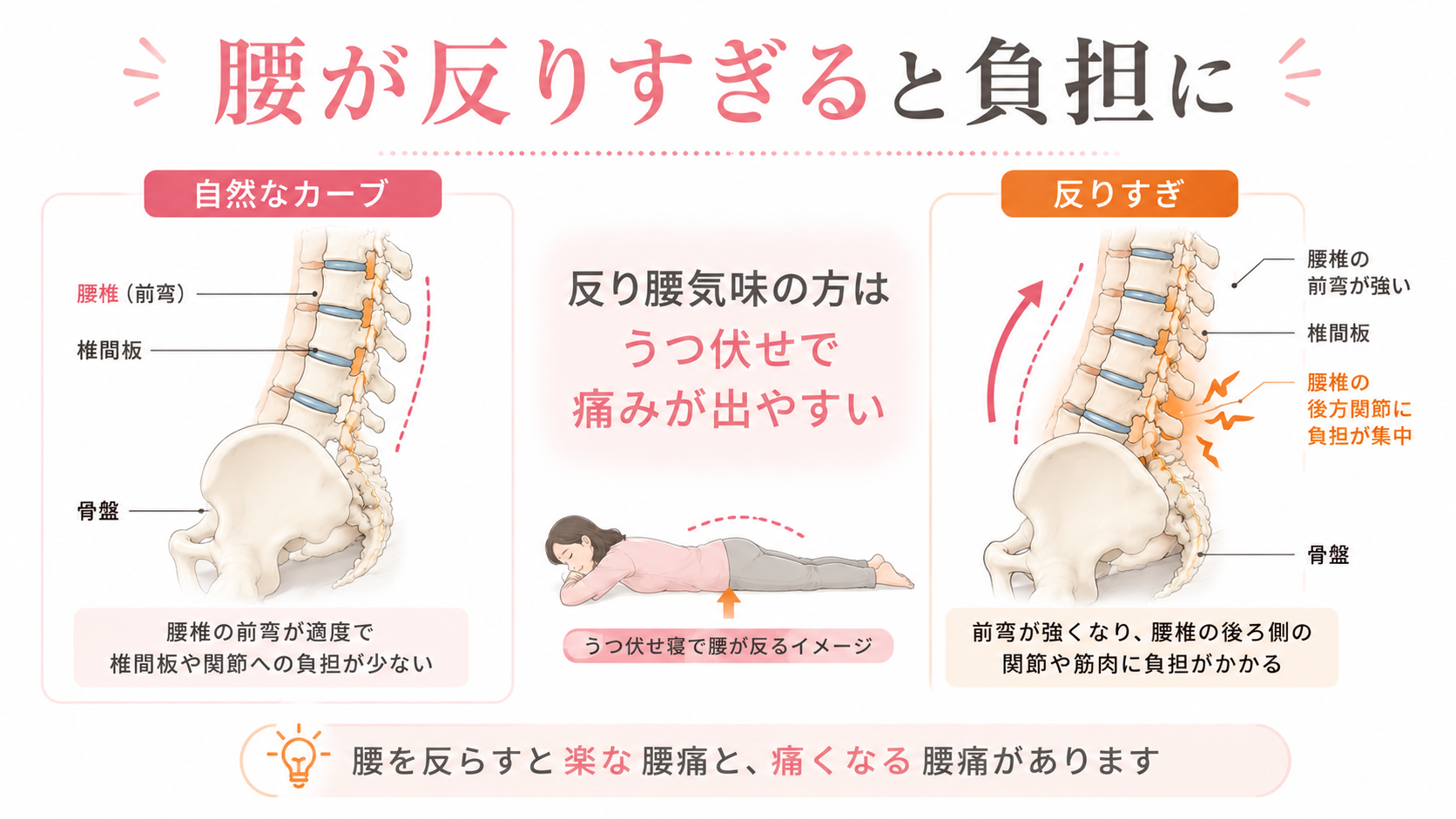 自然な腰椎カーブと反りすぎた腰を比較し、うつ伏せ寝で腰椎に負担がかかる仕組みを説明した医学図解