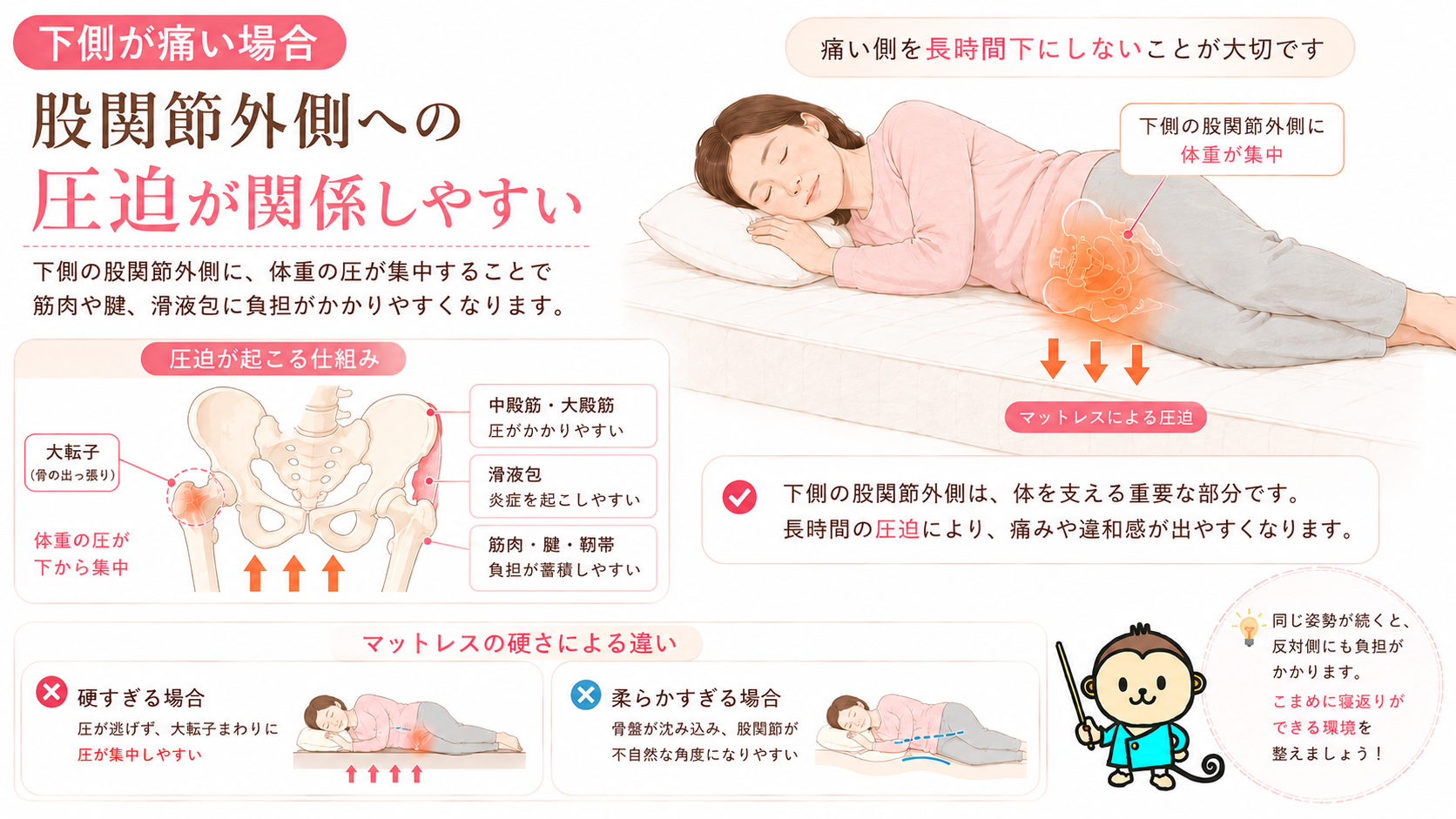 横向き寝で下側の股関節外側に体重が集中し、大転子まわりが圧迫される仕組みを解説した医学図解画像