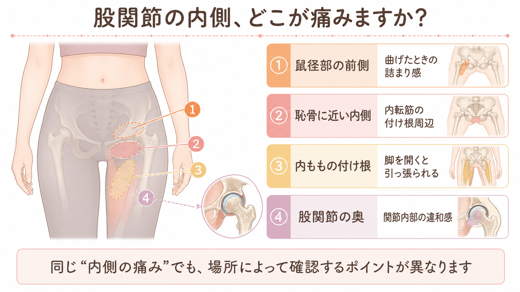 股関節の内側の痛みを、鼠径部の前側、恥骨に近い内側、内ももの付け根、股関節の奥の4か所に分けた図解
