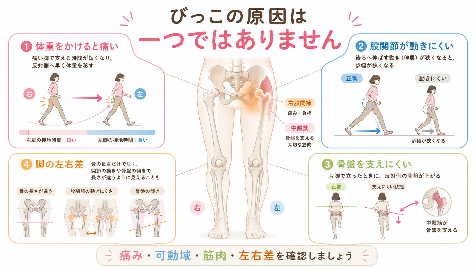 変形性股関節症でびっこを引く原因を、荷重時痛・可動域・骨盤を支える筋肉・脚の左右差に分けた図解