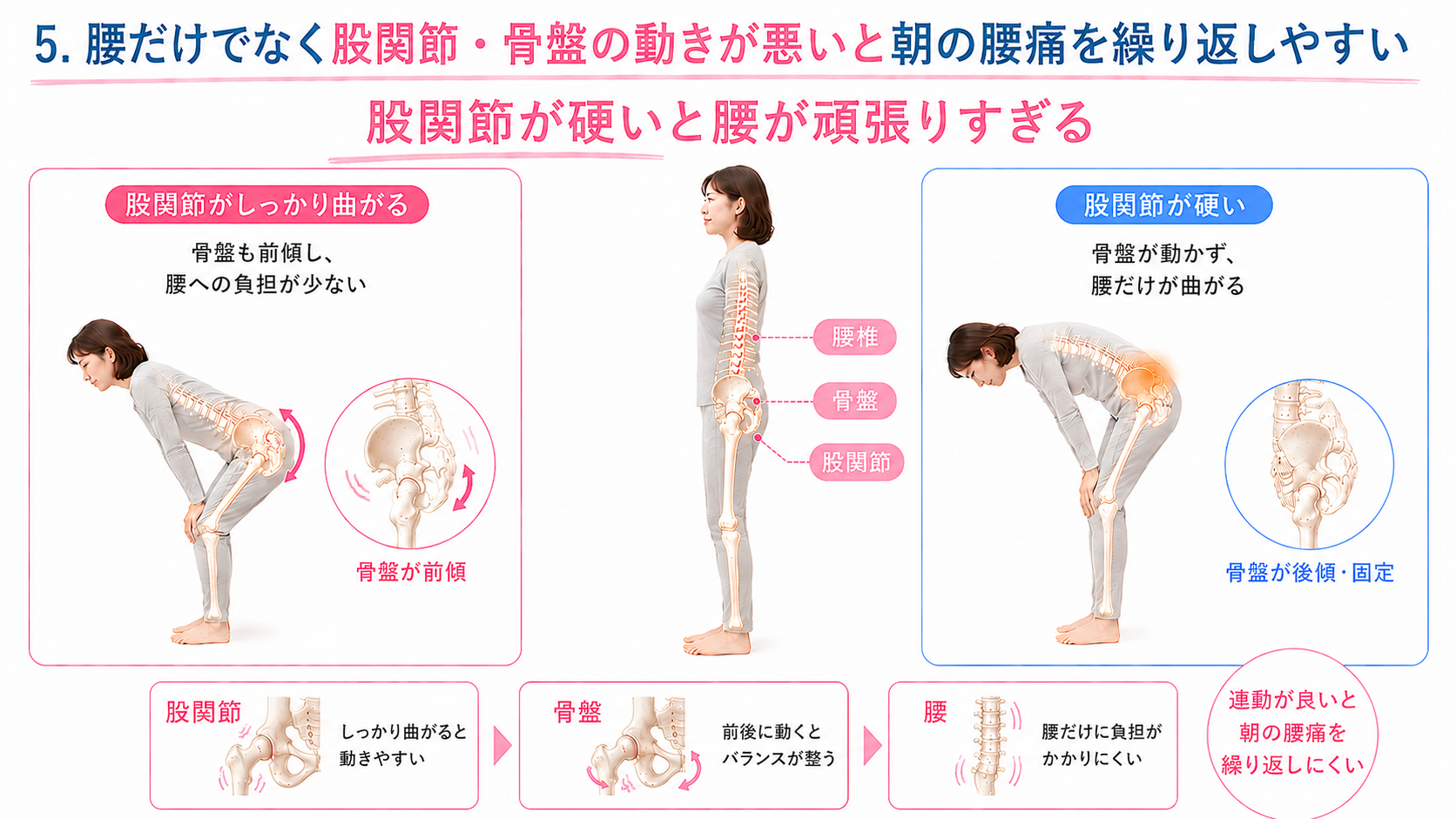 股関節と骨盤の動きが悪いと腰だけが曲がり、朝の腰痛を繰り返しやすくなることを示した画像