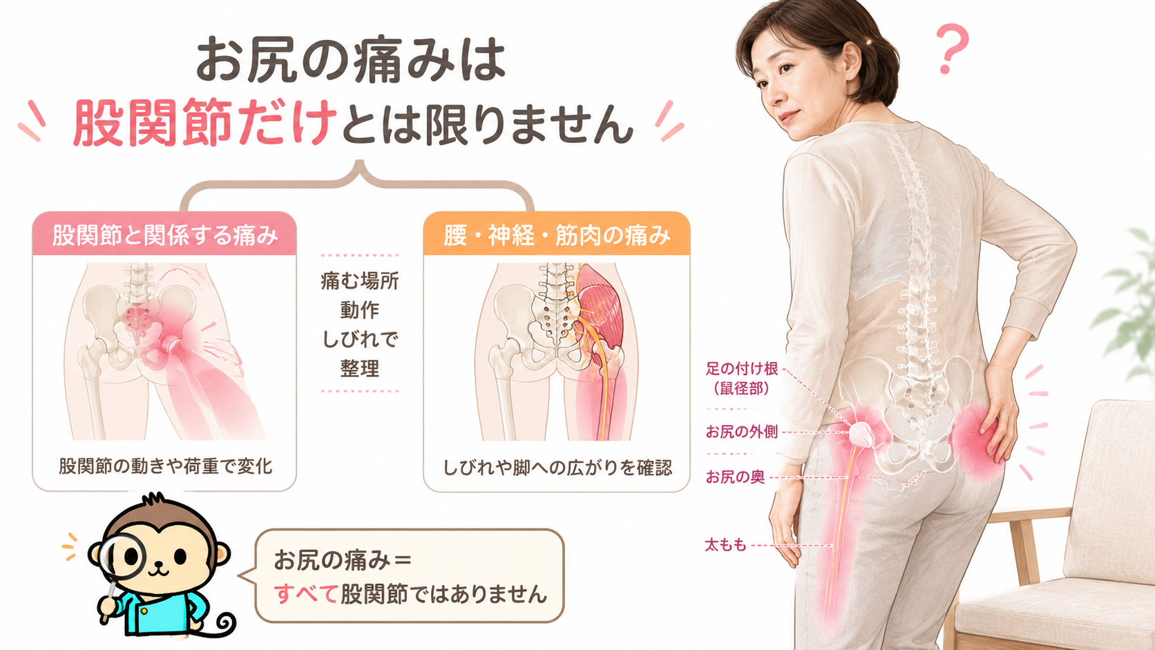 変形性股関節症による股関節周辺の痛みと、腰・神経・筋肉が関係するお尻の痛みの違いを示した図解