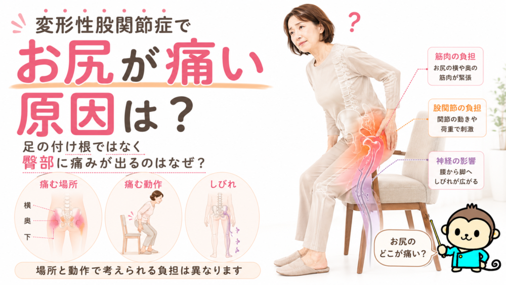 変形性股関節症でお尻が痛い原因｜足の付け根ではなく臀部に痛みが出るのはなぜ？