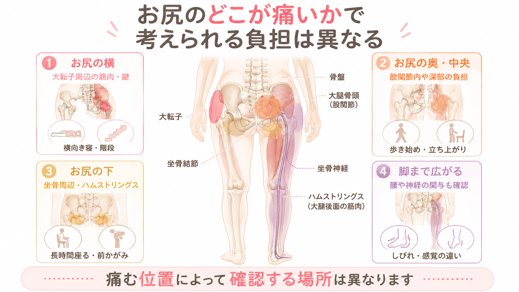 お尻の横、奥・中央、下、脚まで広がる痛みを、大転子、股関節、坐骨、坐骨神経の位置とともに示した人体図
