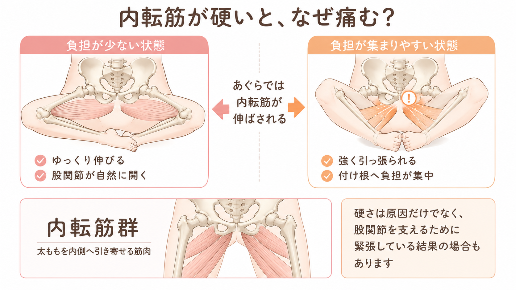あぐらで内転筋がゆっくり伸びる状態と、硬い内転筋が強く引っ張られて付け根へ負担が集中する状態の比較図