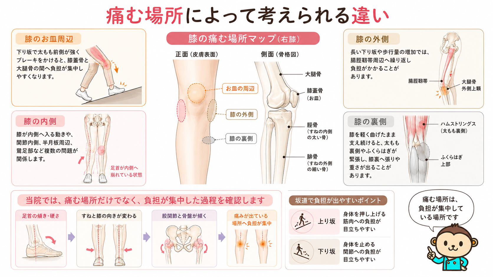 膝のお皿周辺、内側、外側、裏側の痛みの位置と、足首・膝・股関節・骨盤から負担が集中する流れを示した図解