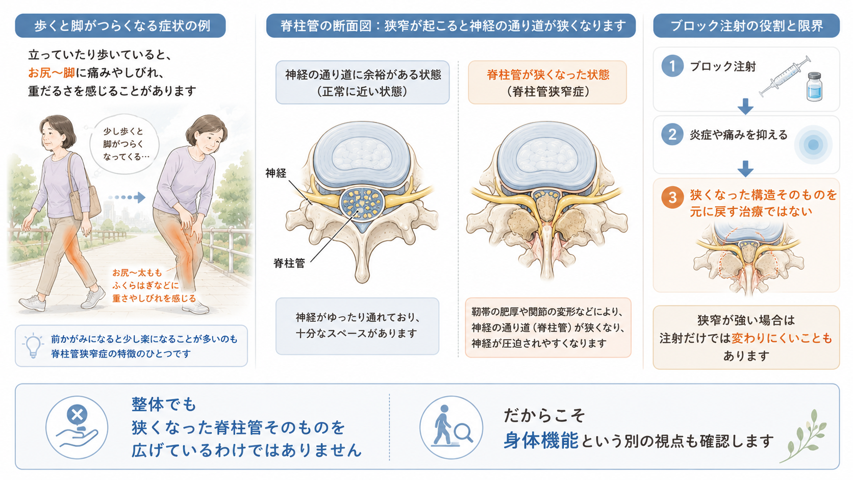 腰部脊柱管狭窄症で歩くと脚が痛む状態と脊柱管の狭窄、ブロック注射で狭窄そのものが元に戻るわけではないことを示した図