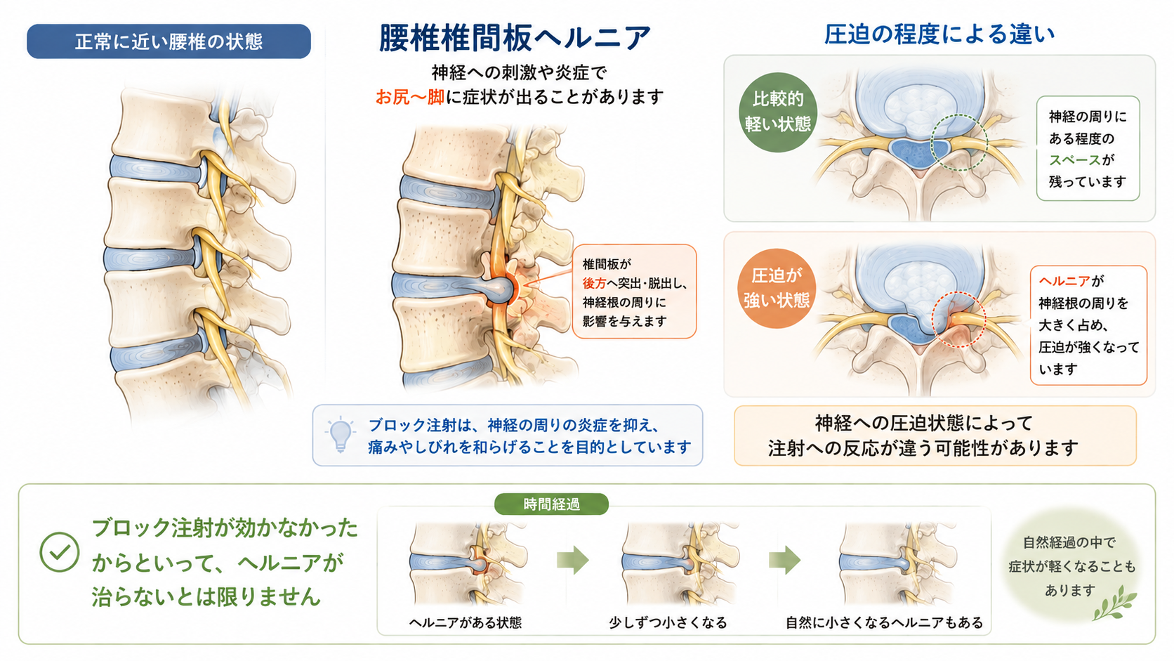腰椎椎間板ヘルニアによる神経根の圧迫状態とブロック注射への反応の違い、ヘルニアが自然に小さくなる経過を示した図