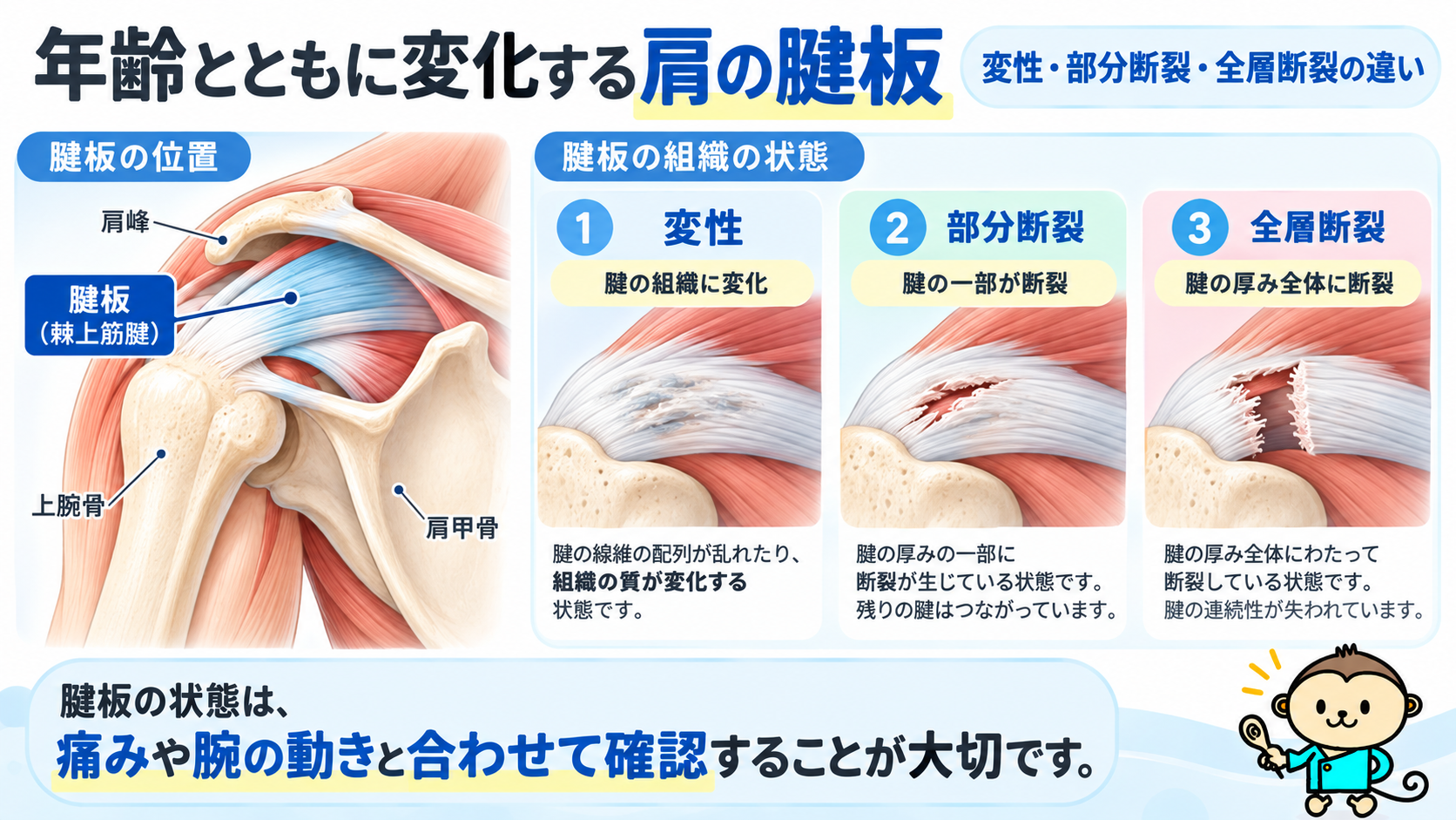 肩関節の腱板の位置と、腱の変性・部分断裂・全層断裂の違いを比較した医学イラスト
